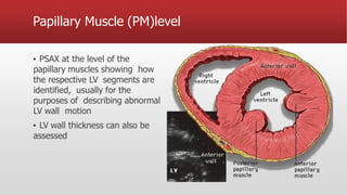 Papillary Muscle (PM)level
▪ PSAX at the level of the
papillary muscles showing how
the respective LV segments are
identified, usually for the
purposes of describing abnormal
LV wall motion
▪ LV wall thickness can also be
assessed
 