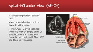 Apical 4-Chamber View (AP4CH)
▪ Transducer position: apex of
heart
▪ Marker dot direction: points
towards left shoulder
▪ The AP5CH view is obtained
from this view by slight anterior
angulation of the transducer
towards the chest wall. The LVOT
can then be visualised
 