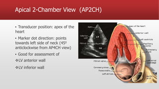 Apical 2-Chamber View (AP2CH)
▪ Transducer position: apex of the
heart
▪ Marker dot direction: points
towards left side of neck (450
anticlockwise from AP4CH view)
▪ Good for assessment of
LV anterior wall
LV inferior wall
 