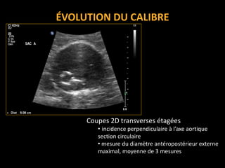 ÉVOLUTION DU CALIBRE
Coupes 2D transverses étagées
• incidence perpendiculaire à l’axe aortique
section circulaire
• mesure du diamètre antéropostérieur externe
maximal, moyenne de 3 mesures
 