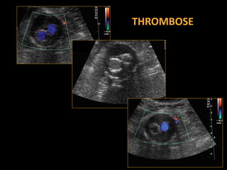 THROMBOSE
 