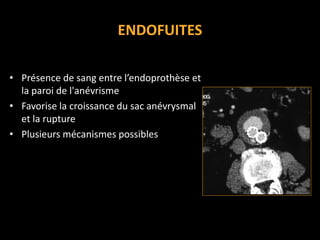ENDOFUITES
• Présence de sang entre l’endoprothèse et
la paroi de l'anévrisme
• Favorise la croissance du sac anévrysmal
et la rupture
• Plusieurs mécanismes possibles
 