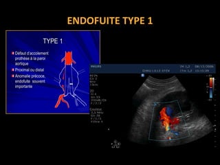 ENDOFUITE TYPE 1
TYPE 1TYPE 1
DDééfaut dfaut d’’accolementaccolement
prothprothèèsese àà la paroila paroi
aortiqueaortique
Proximal ou distalProximal ou distal
Anomalie prAnomalie préécoce,coce,
endofuiteendofuite souventsouvent
importanteimportante
 