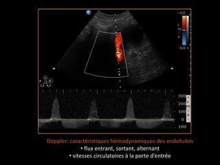 Doppler: caractéristiques hémodynamiques des endofuites
• flux entrant, sortant, alternant
• vitesses circulatoires à la porte d’entrée
 