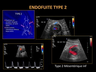 ENDOFUITE TYPE 2
TYPE 2TYPE 2
ReperfusionReperfusion parpar
circulation rcirculation réétrogradetrograde
(branche(s) de l(branche(s) de l’’aorteaorte
native)native)
ArtArtèère lombaire,re lombaire,
mméésentsentéérique infrique inféérieure,rieure,
iliaque interneiliaque interne
Type 2 Mésentérique inf.
 