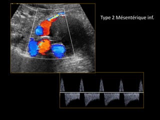 Type 2 Mésentérique inf.
 