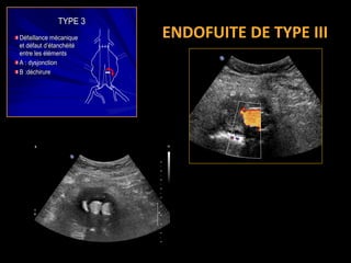 TYPE 3TYPE 3
DDééfaillance mfaillance méécaniquecanique
et det dééfaut dfaut d’é’étanchtanchééititéé
entre lesentre les éélléémentsments
A :A : dysjonctiondysjonction
B :dB :dééchirurechirure
ENDOFUITE DE TYPE III
 