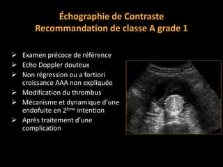  Examen précoce de référence
 Echo Doppler douteux
 Non régression ou a fortiori
croissance AAA non expliquée
 Modification du thrombus
 Mécanisme et dynamique d’une
endofuite en 2ème intention
 Après traitement d’une
complication
Échographie de Contraste
Recommandation de classe A grade 1
 