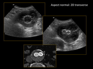 Aspect normal: 2D transverse
 