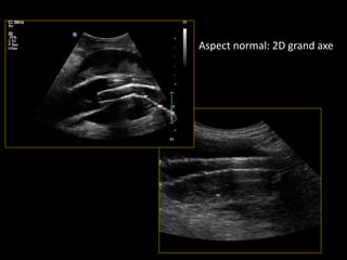 Aspect normal: 2D grand axe
 