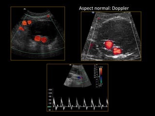 Aspect normal: Doppler
 
