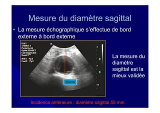 Mesure du diamètre sagittal
• La mesure échographique s’effectue de bord
  externe à bord externe


                                              La mesure du
                                              diamètre
                                              sagittal est la
                                              mieux validée
                       55mm




      Incidence antérieure : diamètre sagittal 55 mm
 