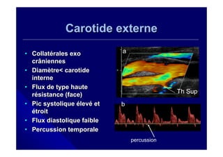 Carotide externe

• Collatérales exo          a
  crâniennes
• Diamètre< carotide
  interne
• Flux de type haute
  résistance (face)                          Th Sup
• Pic systolique élevé et   b
  étroit
• Flux diastolique faible
• Percussion temporale
                                percussion
 