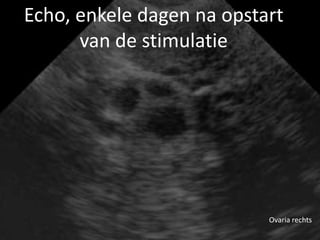Echo, enkele dagen na opstart
      van de stimulatie




                           Ovaria rechts
 