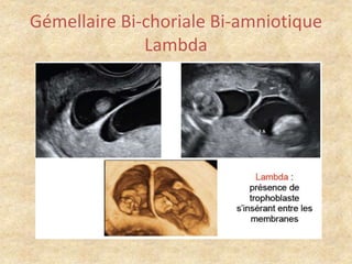 Gémellaire Bi-choriale Bi-amniotique
Lambda

 
