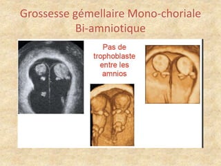 Grossesse gémellaire Mono-choriale
Bi-amniotique

 