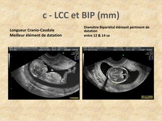 c - LCC et BIP (mm)
Longueur Cranio-Caudale
Meilleur élément de datation

Diamètre Bipariétal élément pertinent de
datation
entre 12 & 14 sa

 