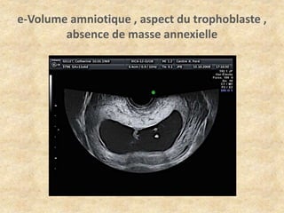 e-Volume amniotique , aspect du trophoblaste ,
absence de masse annexielle

 