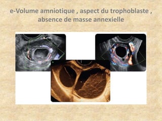 e-Volume amniotique , aspect du trophoblaste ,
absence de masse annexielle

 
