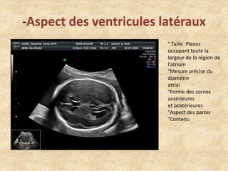 -Aspect des ventricules latéraux
° Taille :Plexus
occupant toute la
largeur de la région de
l’atrium
°Mesure précise du
diamètre
atrial
°Forme des cornes
antérieures
et postérieures
°Aspect des parois
°Contenu

 
