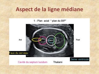 Aspect de la ligne médiane

 