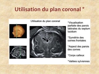 Utilisation du plan coronal °

 