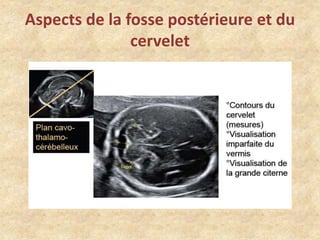 Aspects de la fosse postérieure et du
cervelet

 