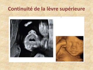 Continuité de la lèvre supérieure

 