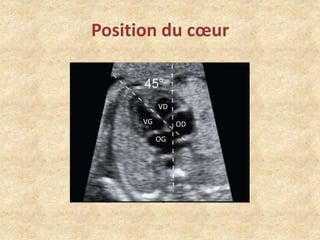 Position du cœur

VD
VG

OD
OG

 