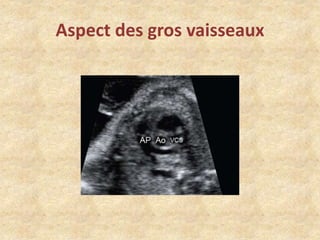 Aspect des gros vaisseaux

 