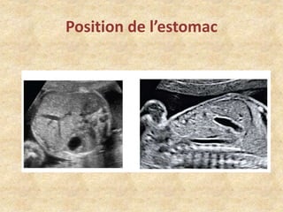 Position de l’estomac

 