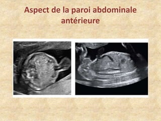 Aspect de la paroi abdominale
antérieure

 