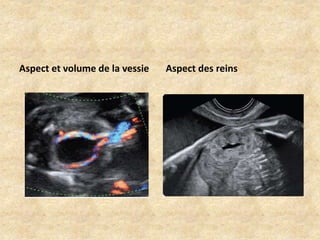 Aspect et volume de la vessie

Aspect des reins

 