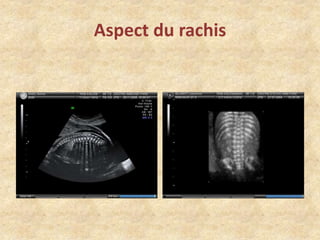 Aspect du rachis

 