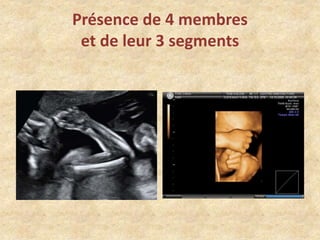 Présence de 4 membres
et de leur 3 segments

 