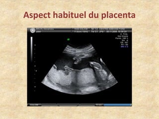 Aspect habituel du placenta

 