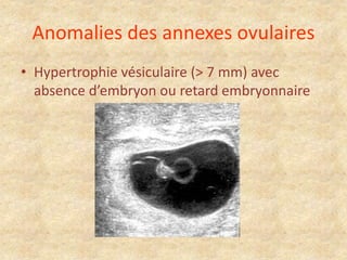 Anomalies des annexes ovulaires
• Hypertrophie vésiculaire (> 7 mm) avec
absence d’embryon ou retard embryonnaire

 