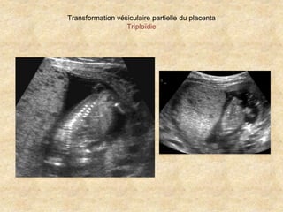 Transformation vésiculaire partielle du placenta
Triploïdie

 