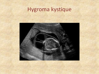 Hygroma kystique

 