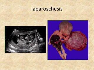 laparoschesis

 