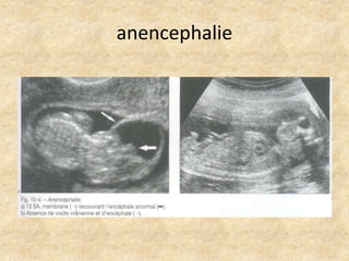 anencephalie

 