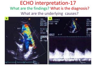 Echo evaluation for DM/D.Card / post graduate fellows/ FCPS examinee | PPSX