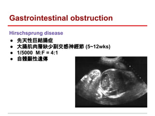 Gastrointestinal obstruction
Hirschsprung disease
● 先天性巨結腸症
● 大腸肌肉層缺少副交感神經節 (5~12wks)
● 1/5000 M:F = 4:1
● 自體顯性遺傳
 