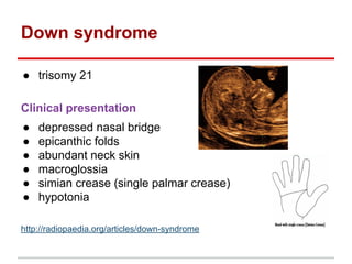 Down syndrome
● trisomy 21
Clinical presentation
● depressed nasal bridge
● epicanthic folds
● abundant neck skin
● macroglossia
● simian crease (single palmar crease)
● hypotonia
http://radiopaedia.org/articles/down-syndrome
 
