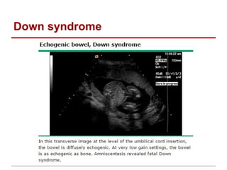 Down syndrome
 