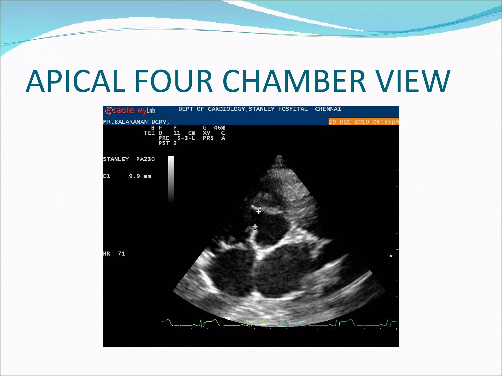 APICAL FOUR CHAMBER VIEW