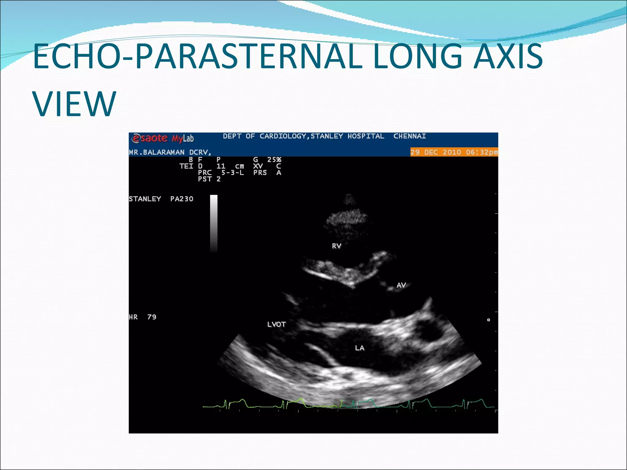 ECHO-PARASTERNAL LONG AXIS VIEW