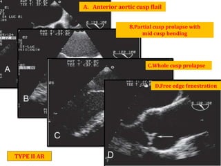 A. Anterior aortic cusp flail
B.Partial cusp prolapse with
mid cusp bending
C.Whole cusp prolapse
D.Free edge fenestration
TYPE II AR
 