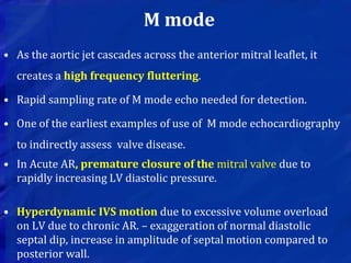 M mode
• As the aortic jet cascades across the anterior mitral leaflet, it
creates a high frequency fluttering.
• Rapid sampling rate of M mode echo needed for detection.
• One of the earliest examples of use of M mode echocardiography
to indirectly assess valve disease.
• In Acute AR, premature closure of the mitral valve due to
rapidly increasing LV diastolic pressure.
• Hyperdynamic IVS motion due to excessive volume overload
on LV due to chronic AR. – exaggeration of normal diastolic
septal dip, increase in amplitude of septal motion compared to
posterior wall.
 