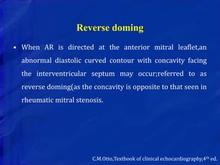 Reverse doming
• When AR is directed at the anterior mitral leaflet,an
abnormal diastolic curved contour with concavity facing
the interventricular septum may occur;referred to as
reverse doming(as the concavity is opposite to that seen in
rheumatic mitral stenosis.
C.M.Otto,Textbook of clinical echocardiography,4th ed.
 